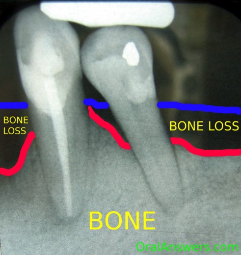 Periodontal Disease Associated Bone Loss