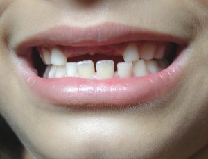 What to Do When a Baby Tooth Gets Knocked Out