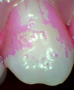 Pink Dental Plaque on a Single Tooth