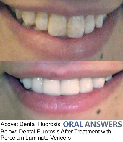 Dental Fluorosis Treatment
