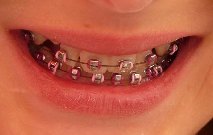 Pink Colored Braces