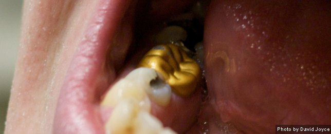 Gold Dental Crown