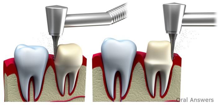 Dental Crown Getting Cut