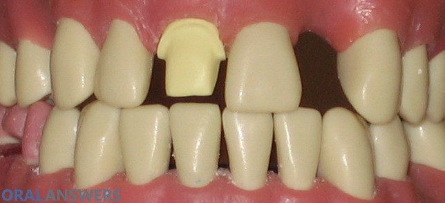 Tooth Prepared for Dental Crown Cap