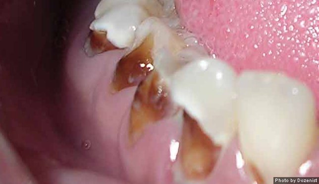 Meth Mouth Closeup