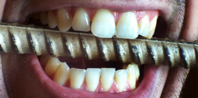 Wearing Away Teeth: Abrasion, Erosion, and Abfraction