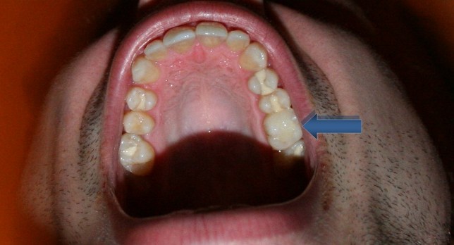 White Composite Dental Fillings