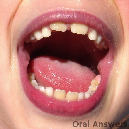 Baby Teeth and Permanent Teeth Comparison