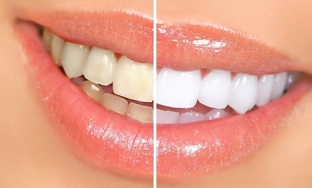 At Home Teeth Whitening: Does It Work?