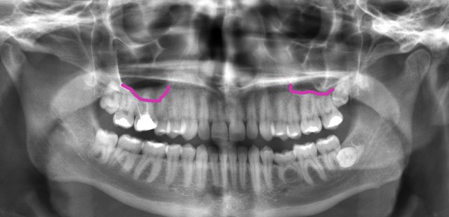 Maxillary Sinuses on a Dental X-Ray