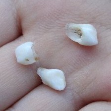 Lost Baby Teeth