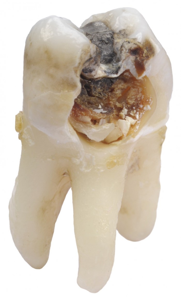 Cavity In a Tooth