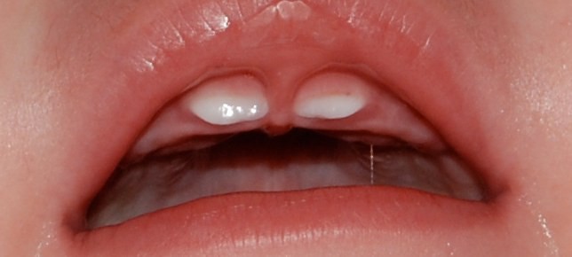 Teething Teeth Through Gums