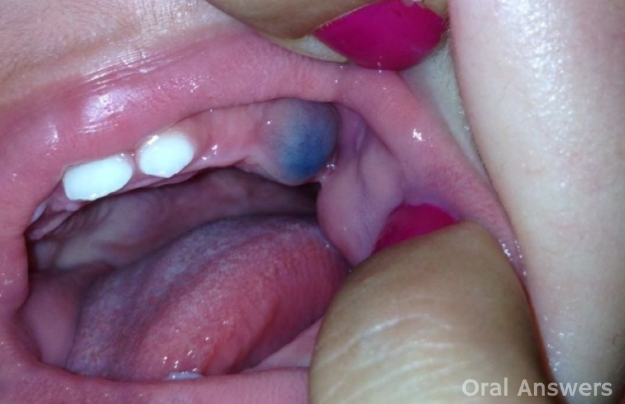 Eruption Cyst: A Purple Blue Bump on Your Babys Gums | Oral Answers