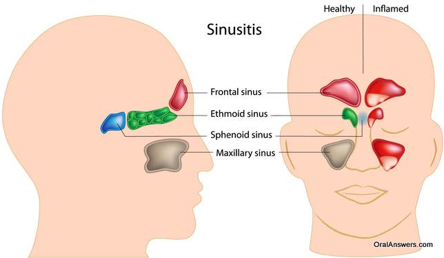Sinusitis Diagram