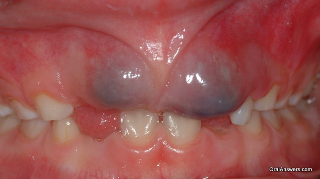 Eruption Cyst Front Teeth
