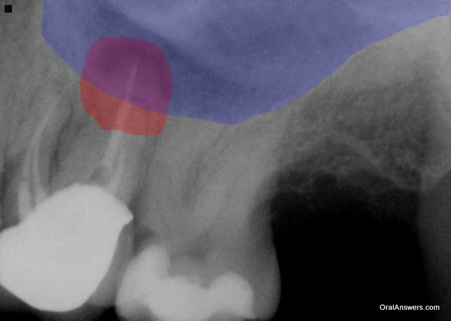 Abscess Near Sinus in a Molar Abscess and Sinus Outlined