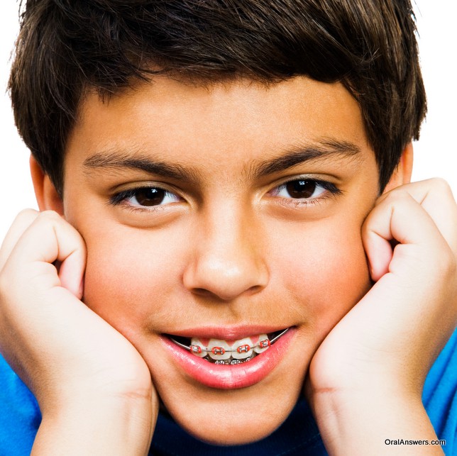 braces_red_colored_bands_teenage_boy