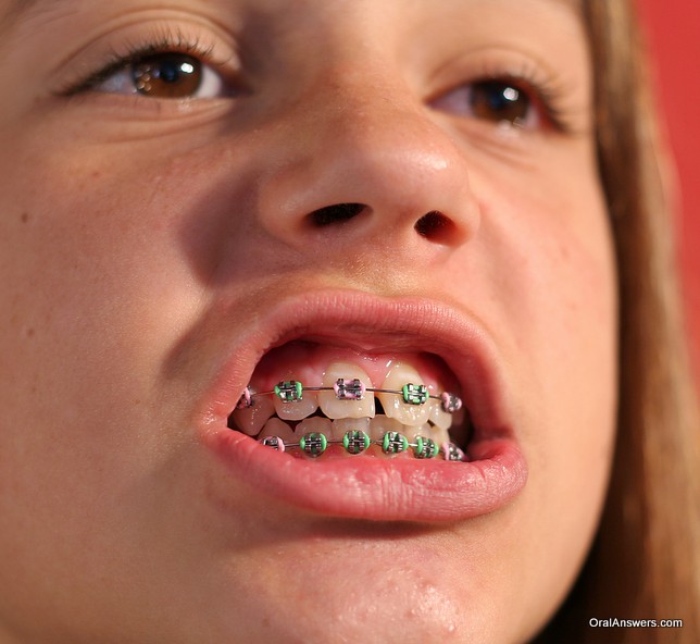 braces_teenage_girl_pink_and_green_bands