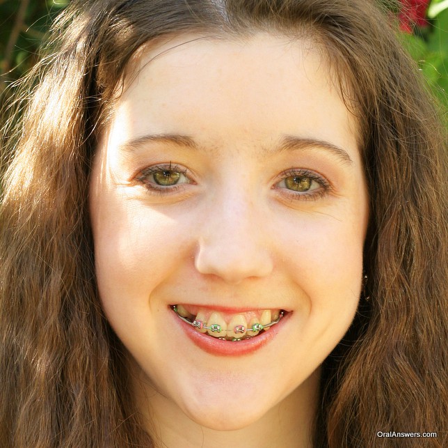 braces_teenager_pink_green_colors