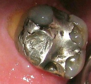 An Amalgam Filling on a Molar Tooth