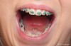 How Long Silver Amalgam Mercury Fillings Last