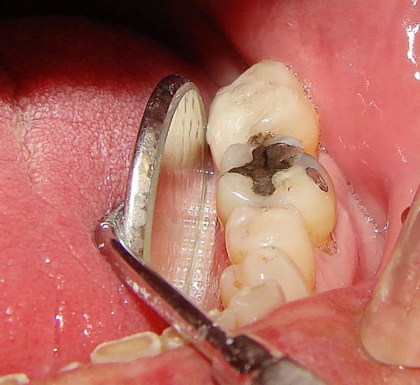 What to Do When You Lose a Filling from Your Tooth Oral Answers