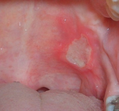 Why is the roof of my mouth swollen?