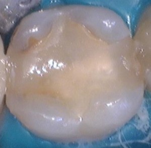 A Composite Filling Courtesy of Michael Ottenbruch on Wikimedia Commons