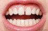 Frenectomy in Children Necessary?