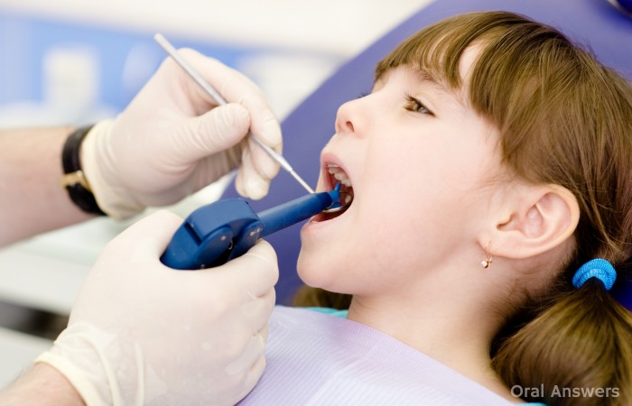 How Long White Composite Fillings Last