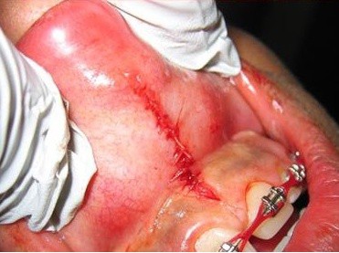 Maxillary Labial Frenectomy.  Photo Courtesy of Dale Rosenbach.