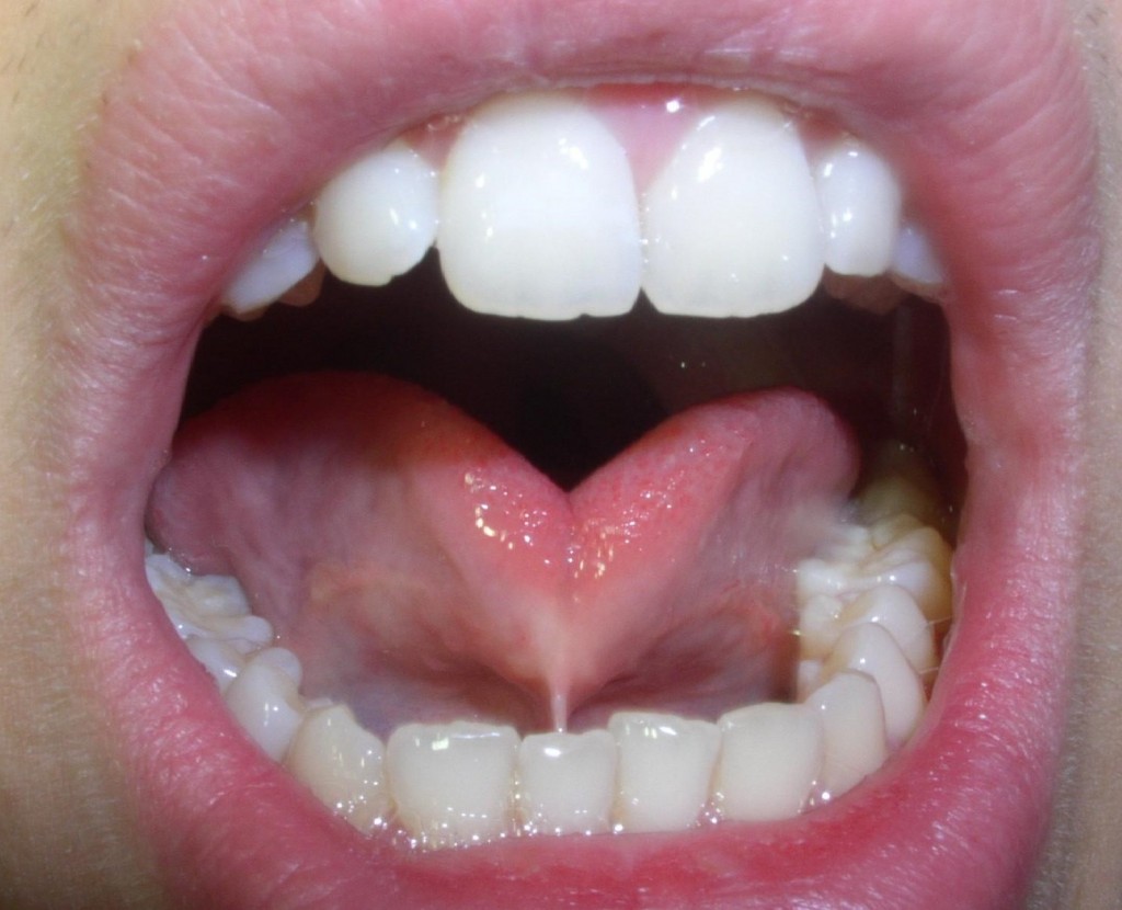 What A Frenectomy Is And Why Your Child Might Need One