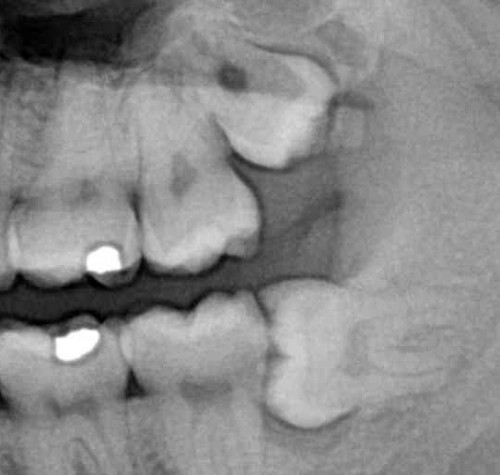 Impacted Wisdom Teeth