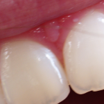 Gums