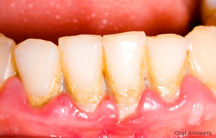 Swollen Gums