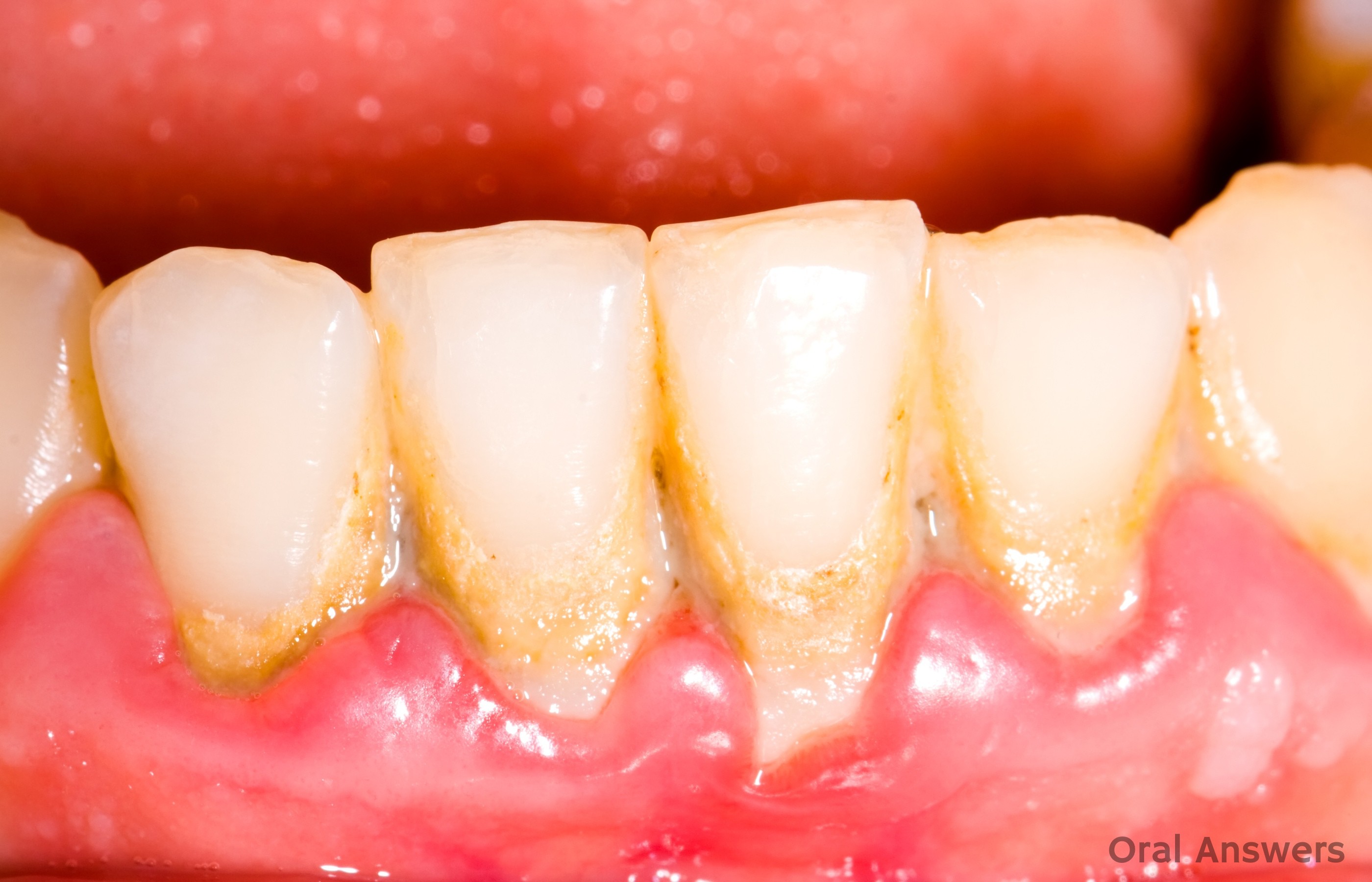 What causes swollen gums in between teeth?