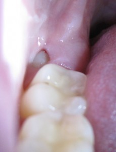 Wisdom Tooth Soft Tissue Impaction