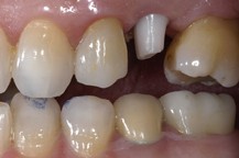 What happens when you get a crown for your tooth?