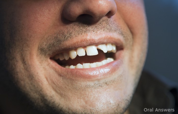Chipped Tooth Fixed Filling