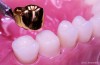 Gold Dental Crown
