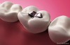 Lost Filling from Tooth