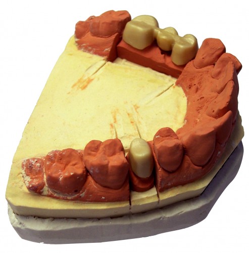 Dental Cast