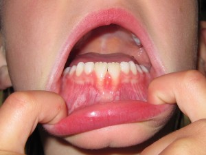 white spots on children's new teeth