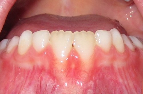 Bumps on Tongue - Diseases Pictures