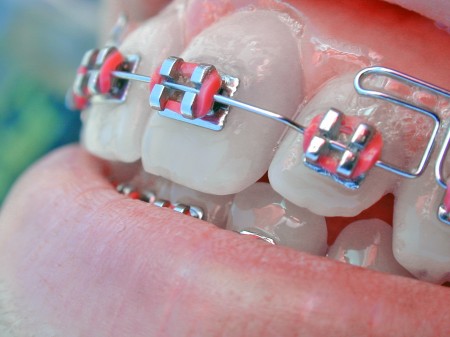 Rubber Bands on Braces
