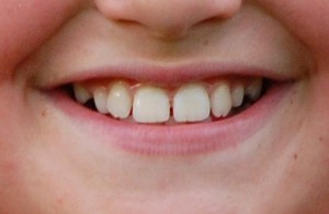 Mamelons Wearing Down on Teeth