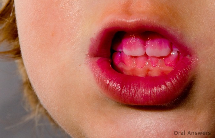 Tongue lexapro and piercing on electricity