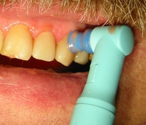 is ultrasonic teeth cleaning painful