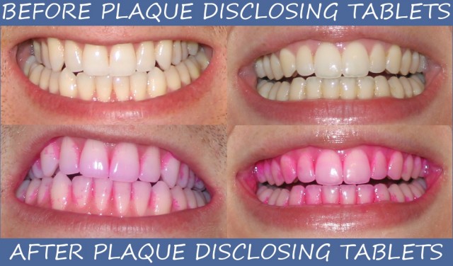 how-plaque-disclosing-tablets-can-help-you-brush-better-oral-answers